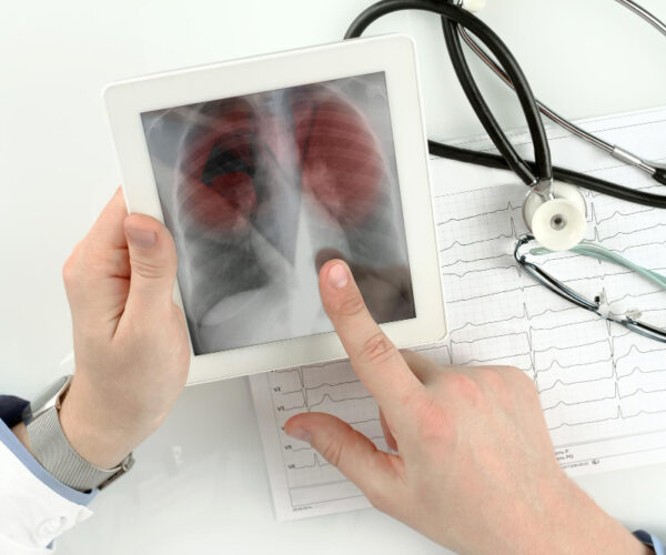 Ipertensione polmonare