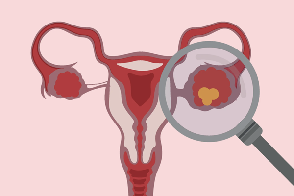Ciste Ovarica Cause Sintomi