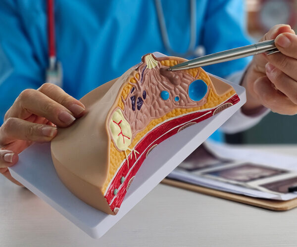 Tipizzazione microistologica su noduli mammari sospetti