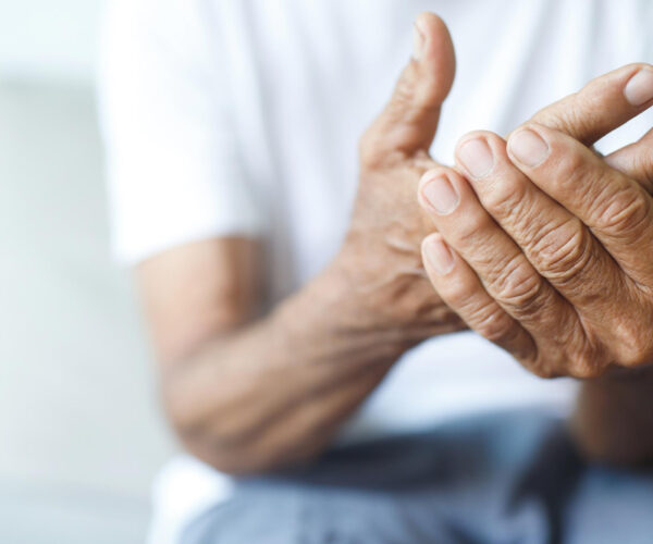 Artrite reumatoide come riconoscerla e cosa fare